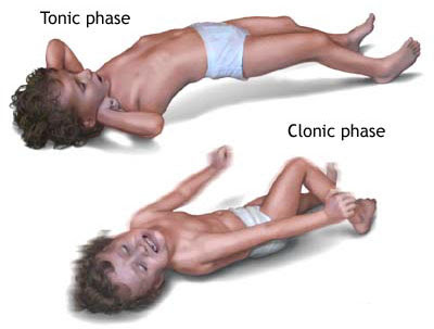The phases of epilepsy in children